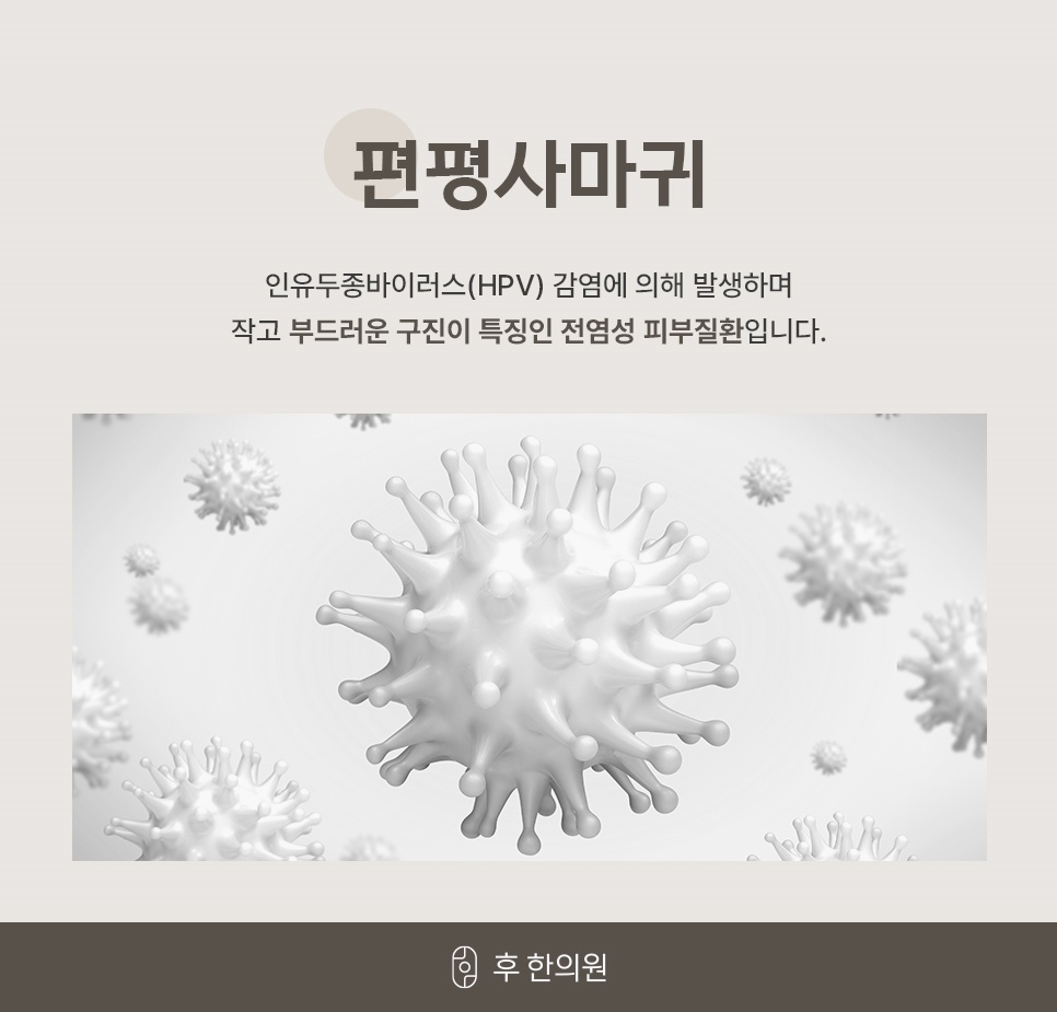 인유두종바이러스 모형 이미지로 소개하는 편평사마귀의 HPV 감염 원인과 전염성