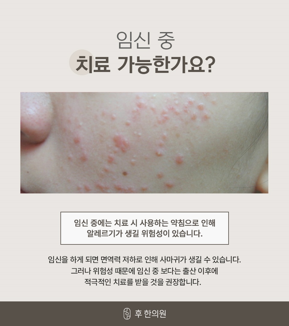 임신 중에는 약침 알레르기 위험이 있어 출산 이후 치료를 권하는 안내