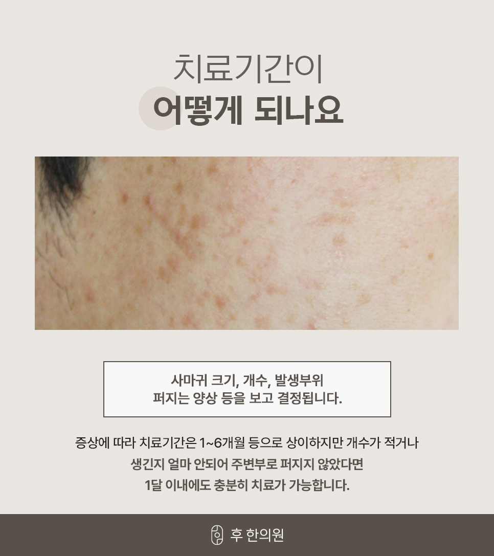 크기·개수·발생부위에 따라 1~6개월로 달라지는 치료기간 안내