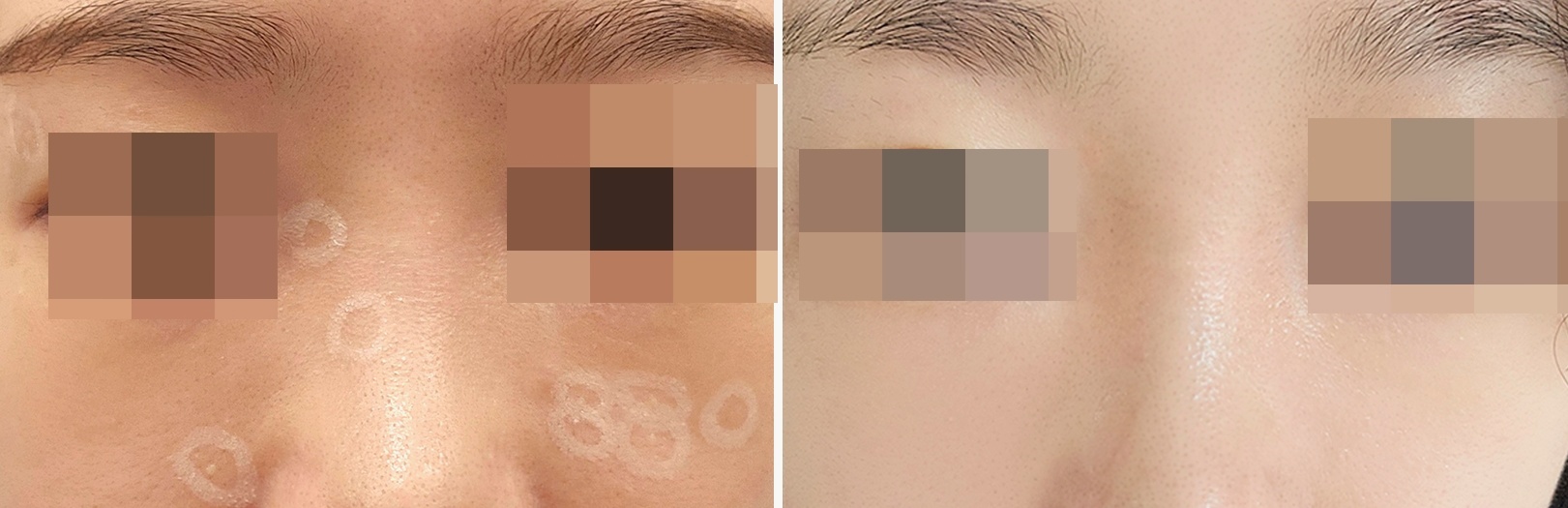 대구 편평사마귀 치료 전후