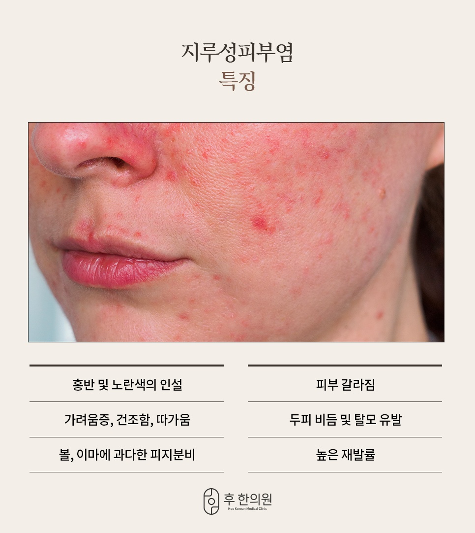 홍반과 노란 인설, 가려움·건조함·따가움, 두피 비듬과 탈모, 높은 재발률로 보는 지루성피부염 특징 6가지
