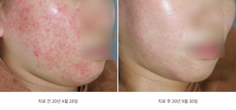지루성피부염 치료 전후 두 번째 사례