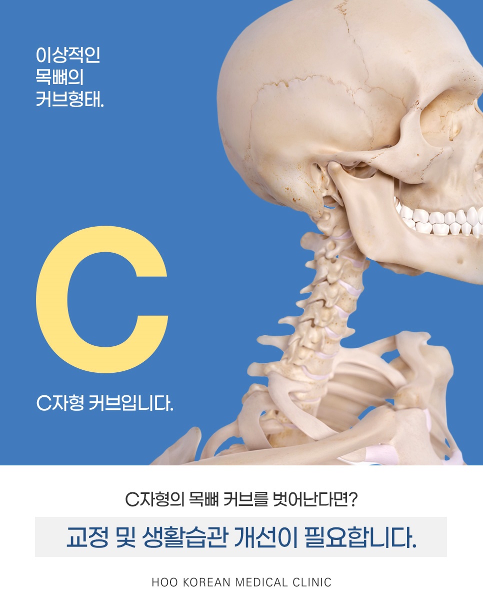 이상적인 목뼈 모양인 C자형 커브와 벗어났을 때 필요한 교정·생활습관 개선