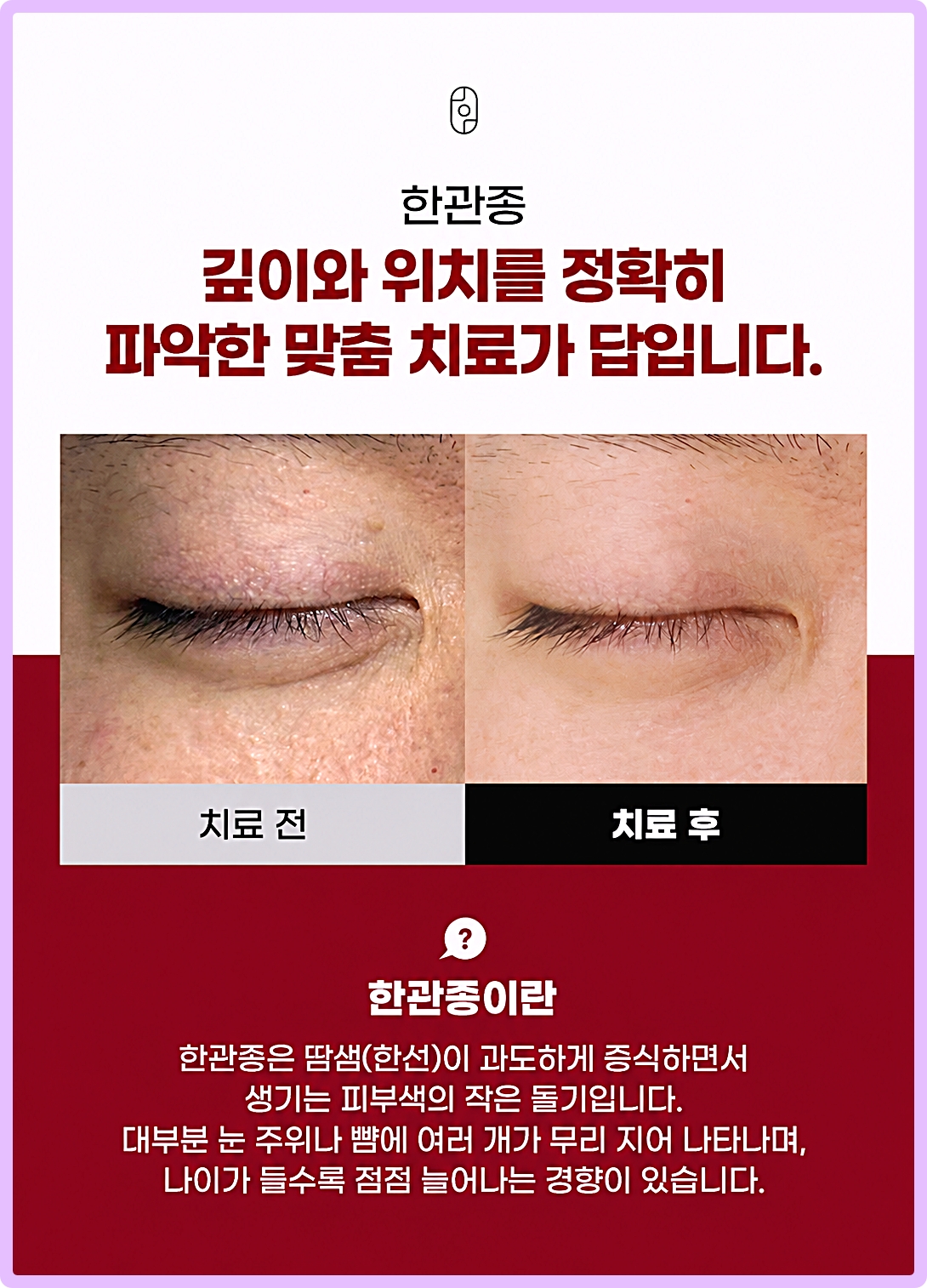 대구잡티제거레이저 후한의원 대구점 한관종 치료 전후 안내