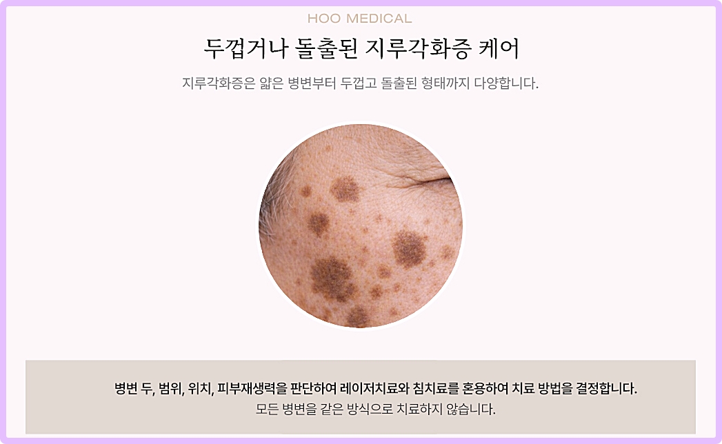 후한의원 대구점 지루각화증 케어 안내 레이저치료와 침치료 혼용