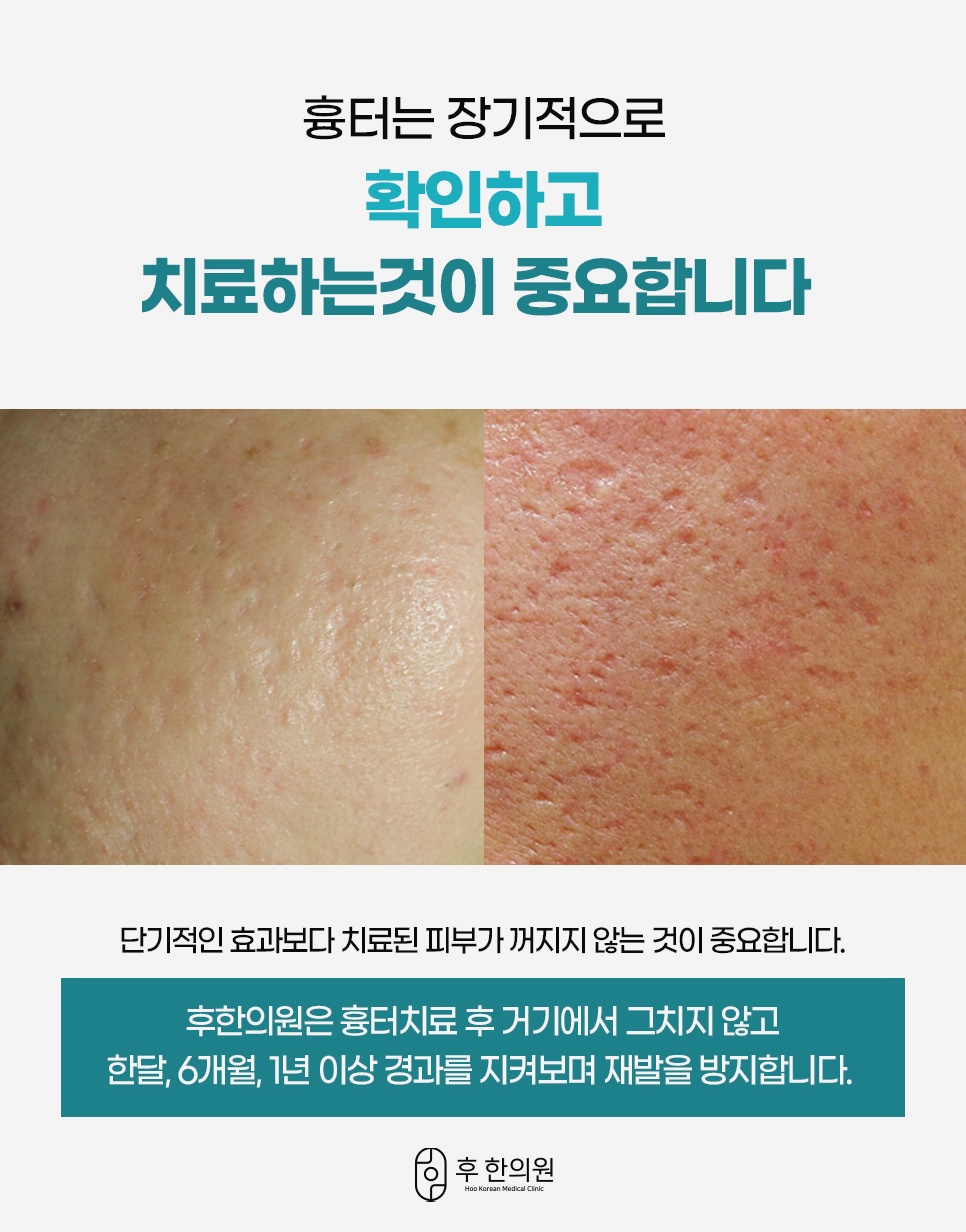 새살침 흉터치료 후 장기 경과 관리